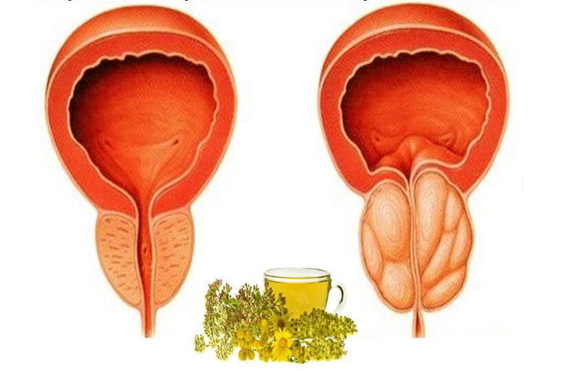 Healthy and painful prostate